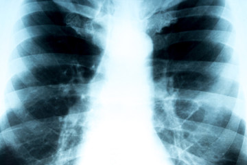 X-ray of the chest