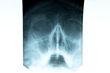 X-ray of the nasal septum