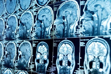 MRI scan of the brain