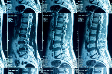 MRI scans of the lumbosacral spine - obrazy, fototapety, plakaty