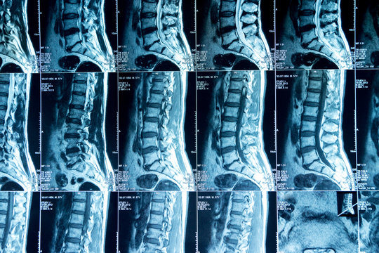 MRI scans of the lumbosacral spine