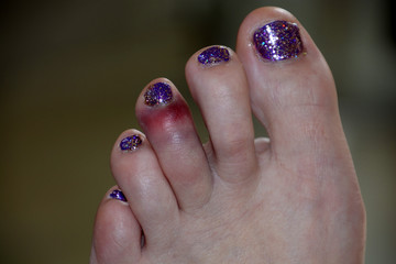 dislocated toe bruising after sport mistake, black and blue bruise on the left foot of the middle toe of a female after a painful accident