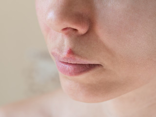 Cold sores. Close-up of the female face. - obrazy, fototapety, plakaty