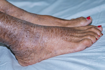 Ichthyosis on woman feet