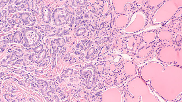 Thyroid gland cancer awareness: Microscopic image of papillary thyroid carcinoma, follicular variant (left), with invasion into benign follicles or normal thyroid tissue (right).