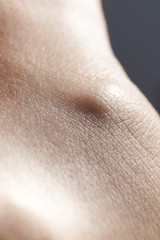 Fototapeta premium Painful arthritis on the foot of a white woman.