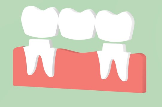 dental crown with bridge, installation process and change of teeth - tooth cartoon 3d render