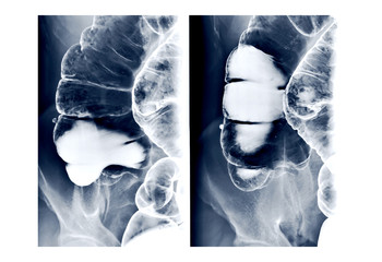Spot film barium enema image or x-ray image of large intestine or colon showing anatomical of large intestine or colon for diagnosis Colorectal cancer.