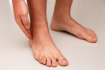Obraz na płótnie Canvas swollen leg after ankle sprain