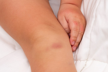 Big bruise on baby's knee