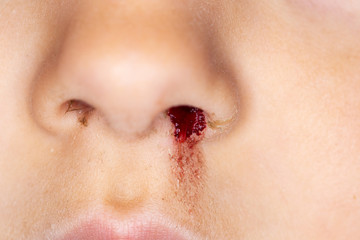 Closeup of a small caucasian child with a bleeding nose