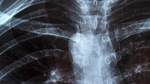 Chest X-ray image for physicians examination