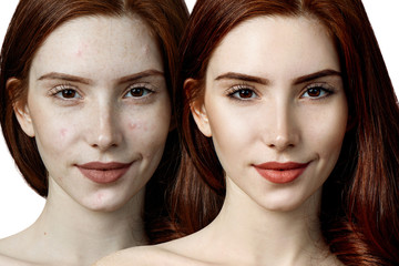 Young woman before and after skin treatment and makeup.