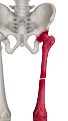 Broken upper leg or thigh bone- femur fracture anterior view completed displaced fracture type with red highlight on pain- Medical Biomedical illustration -Isolated on white background.