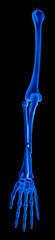 X-ray of the ulna and radius fractures or broken arms completed displaced fracture type- Anterior view- 3D Medical- Biomedical illustration- Healthcare- Blue tone color