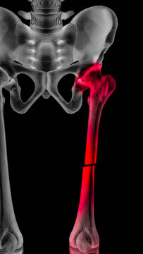 X-ray of broken upper leg or femur fracture anterior view completed displaced fracture type red highlight on pain area- 3D Medical illustration- Human Anatomy and Medical Concept- on black background