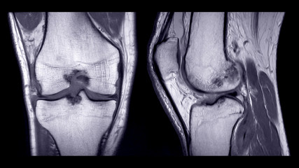 Magnetic resonance imaging or MRI of right knee comparison coronal and sagittal view.