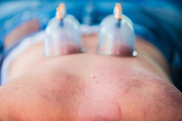 The back of the man with blood marks by cupping treatment,Cupping therapy marks on the back,Chinese...