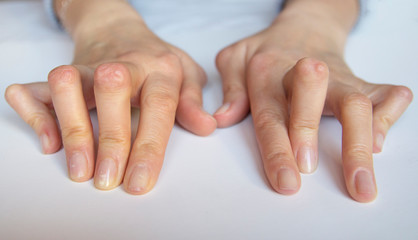 Young woman's hands deformed from Rheumatoid Arthritis.