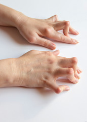 Young woman's hands deformed from Rheumatoid Arthritis.