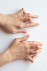 Young woman's hands deformed from Rheumatoid Arthritis.