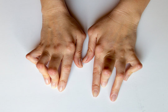 Young woman's hands deformed from Rheumatoid Arthritis.