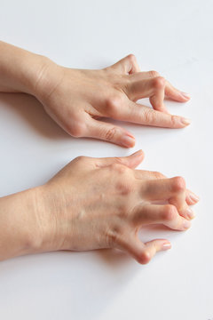 Young woman's hands deformed from Rheumatoid Arthritis.