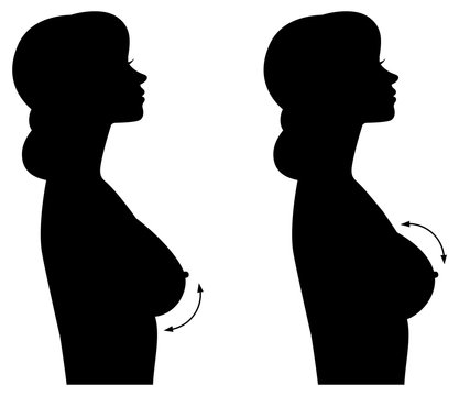 Silhouette Woman In Profile Of Different Forms Of Breasts And Breast Implants.