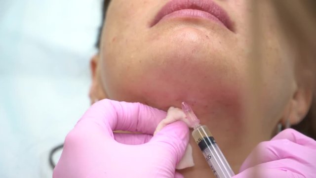 The cosmetologist performs several injections in the chin area of the girl to the patient. Botox injection.