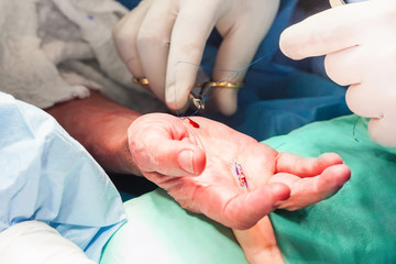 Surgeon suturing the hand of a patient at the end of surgery