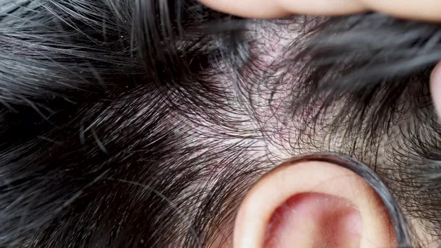 Skin diseases, on the scalp ,Woman with dandruff in her dark hair