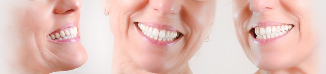 Set of three views of natural dentition of caucasian woman