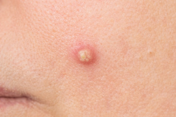 Closeup view of big ugly pimple on skin of face of woman. Horizontal color photography,