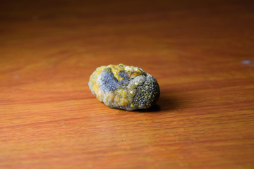 Large gallstone, Gall bladder stone. The result of gallstones
