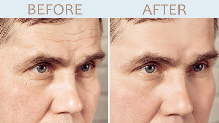 Face of a mature man before and after cosmetic rejuvenating procedures