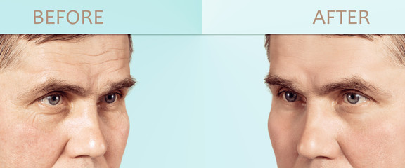 Face of a mature man before and after cosmetic rejuvenating procedures, with copy space in the center