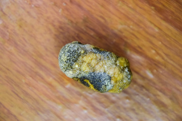 Large gallstone, Gall bladder stone. The result of gallstones