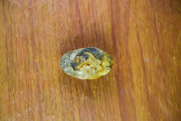 Large gallstone, Gall bladder stone. The result of gallstones