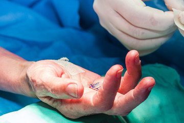 Surgeon bandaging the hand of a patient at the end of surgery