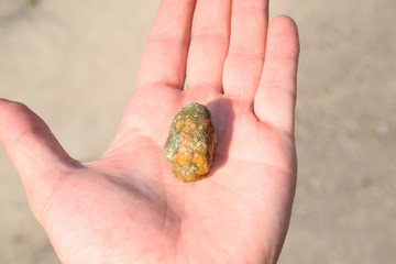 Gallstone in hand, Gall bladder stone. result of gallstones. Calculus of heterogeneous composition