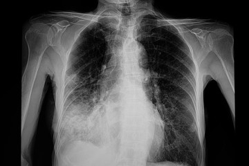 chest xray film of the patient with pneumonia right lower lung. Covid-19 pneumonia. Covid lung infection. - obrazy, fototapety, plakaty