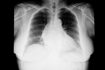 chest xray of the patient with cardiomegaly