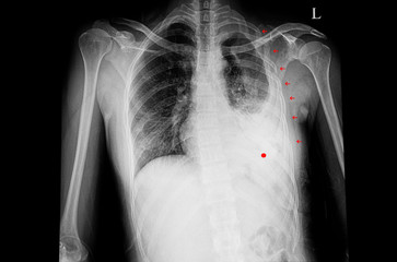 chest xray of the patient with multiple rib fractures and left hemothorax