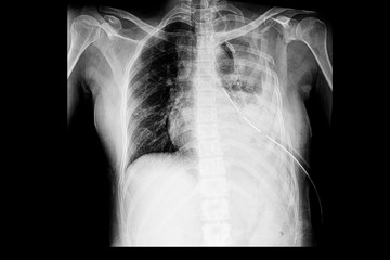 chest xray of the pateint with multiple rib fractures with hemothorax