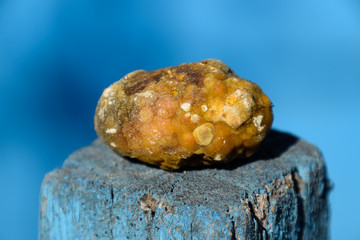 Gall bladder stone. Calculus of heterogeneous composition