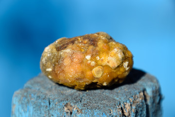 Gall bladder stone. Calculus of heterogeneous composition