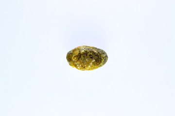 Large gallstone, Gall bladder stone. result of gallstones. Calculus of heterogeneous composition