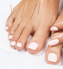 Female legs with insert acupuncture needles.