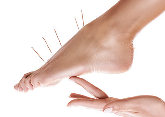 Female legs with insert acupuncture needles. - obrazy, fototapety, plakaty