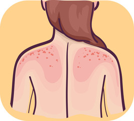 Back Symptoms Skin Sensitive Sunburn Illustration